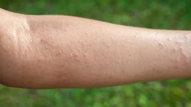 milben hautausschlag bilder